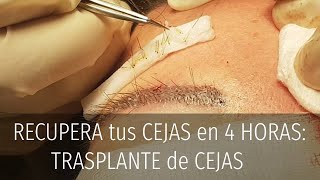 RECUPERA tus CEJAS en 4 HORAS TRASPLANTE de CEJAS [upl. by Tove]