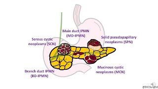 Neoplasia Nomenclature  Benign Tumors  Adenoma  Papilloma [upl. by Anatol]