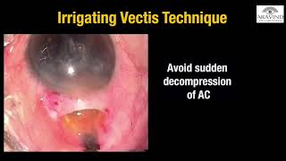 Episode 5  Nucleus delivery and Cortex aspiration in MSICS [upl. by Elleimac]