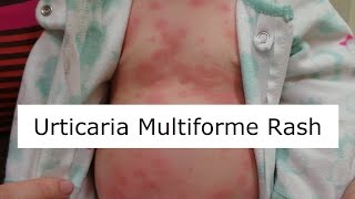 Urticaria Multiforme Rash [upl. by Aruabea]