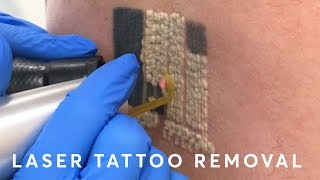 Laser Tattoo Removal PAIN RESULTS amp PROCEDURE [upl. by Tyrus257]