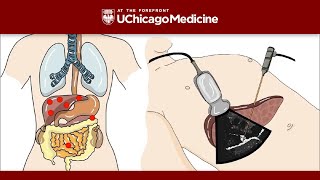 Pancreas Ductal adenocarcinoma [upl. by Esilec]