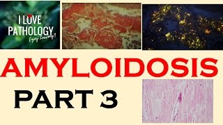 AMYLOIDOSIS PART 3 Morphology Diagnosis Special stains clinical features amp Prognosis [upl. by Nigen]