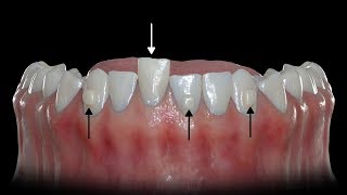 How Buttons Help Clear Aligners [upl. by Gottlieb]