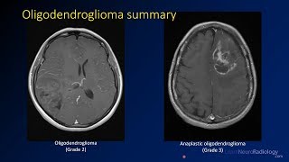 Imaging brain tumors  3  Oligodendrogliomas [upl. by Jowett]