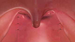 Sphincter Pharyngoplasty to Treat VPI [upl. by Trevorr]