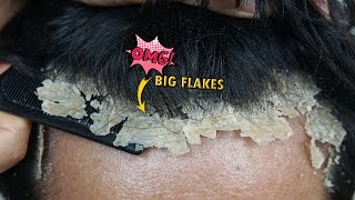 Satisfying Itchy Dry Scalp Scratching Dandruff 1187 [upl. by Bevis]