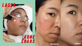 Picosure Laser for Acne Scars amp Hyperpigmentation Before amp After [upl. by Dnalerb]