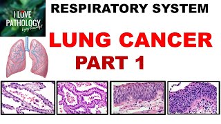 31 Medical Coding of Neoplasms Part 3 [upl. by Anatlus]