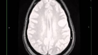 Granulomatous Inflammation Possible IgG4 Disease [upl. by Tulley981]