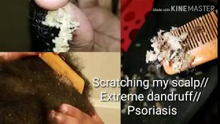 Scratching my scalp Extreme dandruff psoriasis [upl. by Armilda645]