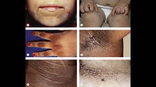 Acanthosis nigricans [upl. by Icak]