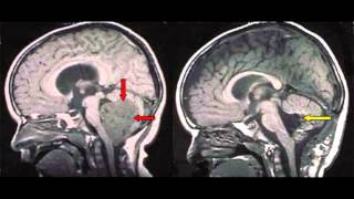 Brain Tumor Overview [upl. by Waddle]