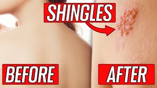 Symptoms and Prevention for Shingles  San Diego Dermatology  Dr Goldman [upl. by Corene]