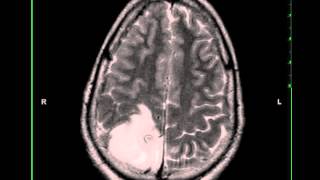 Oligodendroglioma [upl. by Emanuel323]