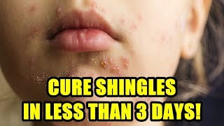 How Long Does Shingles Last [upl. by Melquist]