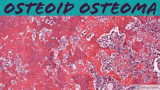 Osteoid Osteoma Bone Pathology Basics [upl. by Joao]