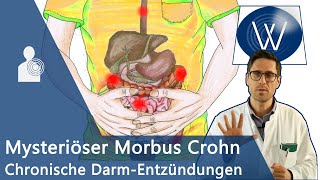 Morbus Crohn Ursache für unblutigen Durchfall amp Bauchschmerz Chronischentzündliche Darmerkrankung [upl. by Ilera]