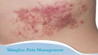 What is Shingles [upl. by Adnarim]